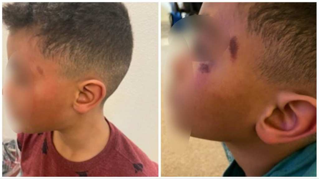 Injuries to the face of a former Cheyenne second grader